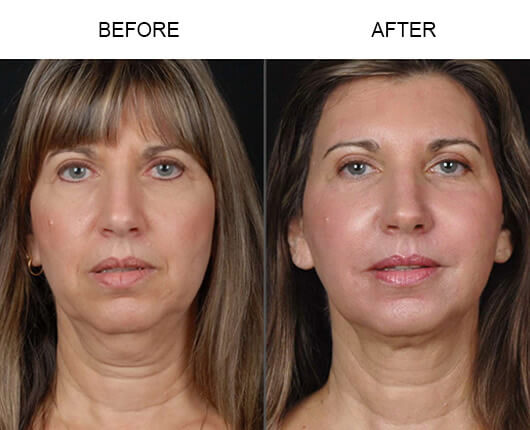 Face Lift Roller